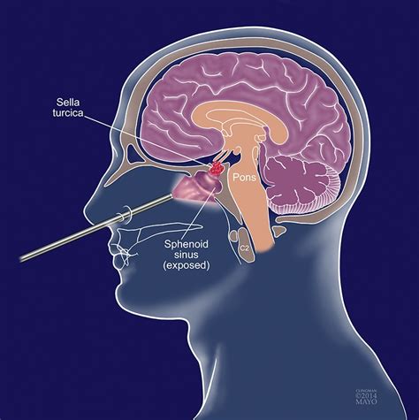 transsphenoidal pituitary tumor biopsy